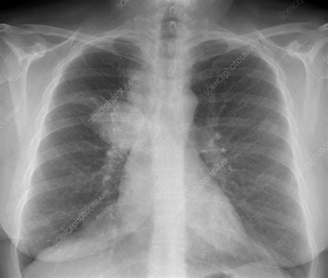 Lung Cancer X Ray Stock Image C0529813 Science Photo Library