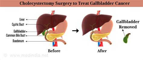 Gallbladder Cancer Types Causes Symptoms Diagnosis Treatment Prognosis
