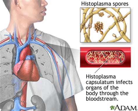 Disseminated Histoplasmosis MedlinePlus Medical Encyclopedia Image