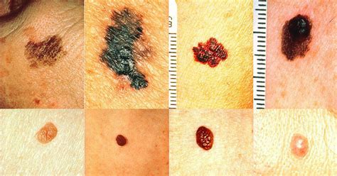How To Recognize Skin Cancer This Could Save Your Life