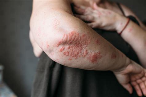 Psoriasis On Elbow Stock Photo Image Of Hand Eczema 97215386