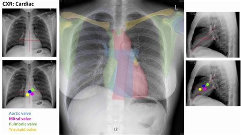 L the portion of the left lung that corresponds anatomically to the right middle lobe is incorporated into the left upper lobe. Anatomy of a Chest XRay - YouTube