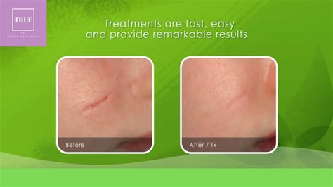 Laser Scar Removal In Las Vegas Youtube