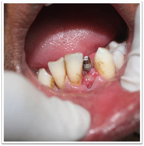 Zirconia crown cementation in india-for lower front tooth implant