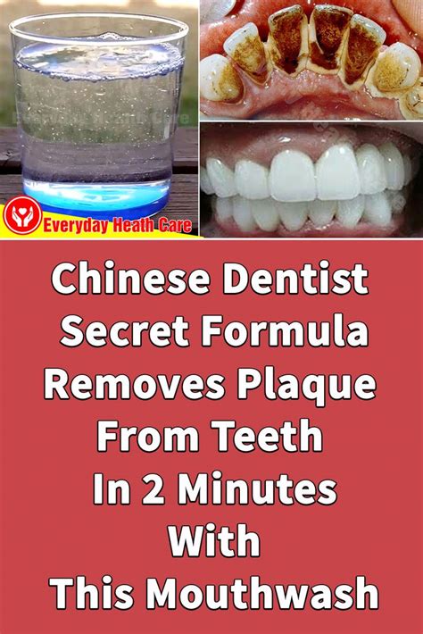 chinese dentist secret formula removes plaque from teeth in 2 minutes