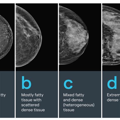 New Law Expands Insurance For 3d Mammography Dense Breasts Kettering