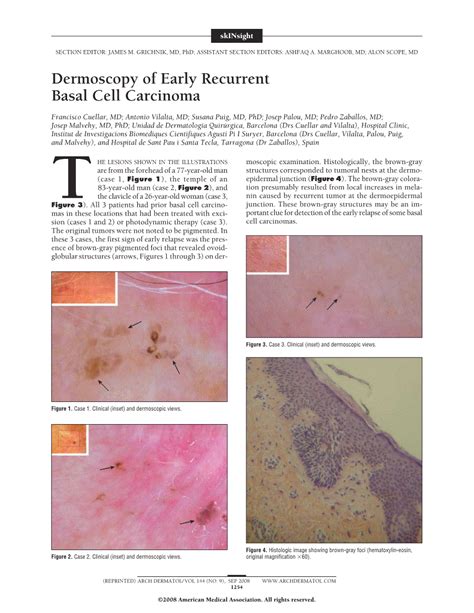 Dermoscopy Of Early Recurrent Basal Cell Carcinoma Dermatology Jama