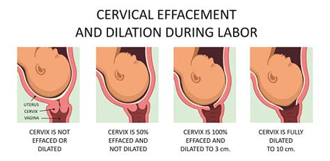 cervix thinning and widening during labor stock illustration download image now cervix