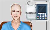 Side Effects Of Ta Otere Chemotherapy For Prostate Cancer Pictures