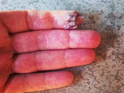 Annika Sorenstam Cut Off A Part Of Her Finger Then Tweeted A Picture Of It