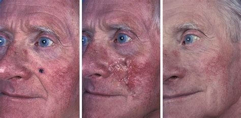 Facial Skin Cancer