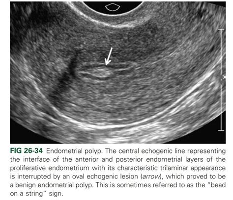 Baby Ultrasound Sonogram Fibroid Uterus Cervix Sonography Student