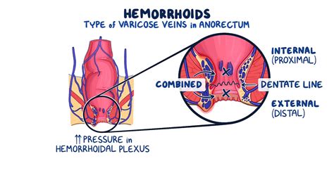 Hemorrhoids Clinical Sciences Osmosis Video Library