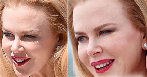 Nicole Kidman Botox Rifatti Chirurgia Estetica Vip