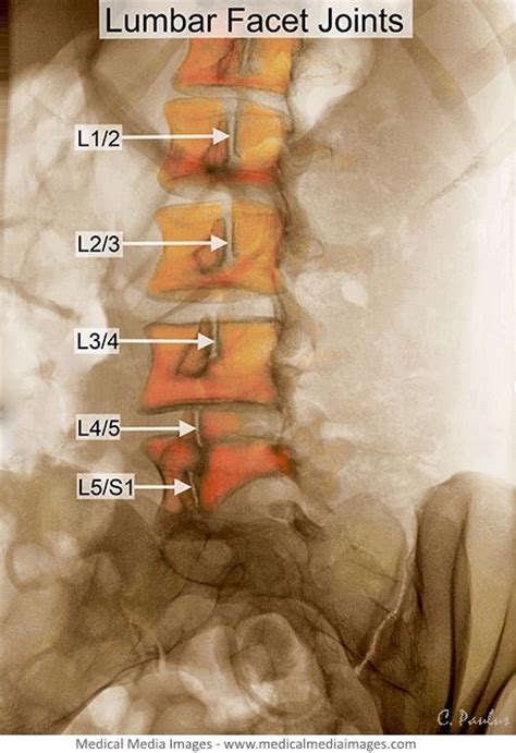 Pin On Lumbar Facet Joints Shown On Color X Rays And Mri Scans