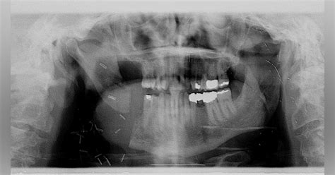 Bc Oral Pathology Case No 49 Unfortunate Outcomes For A Wonderful Man