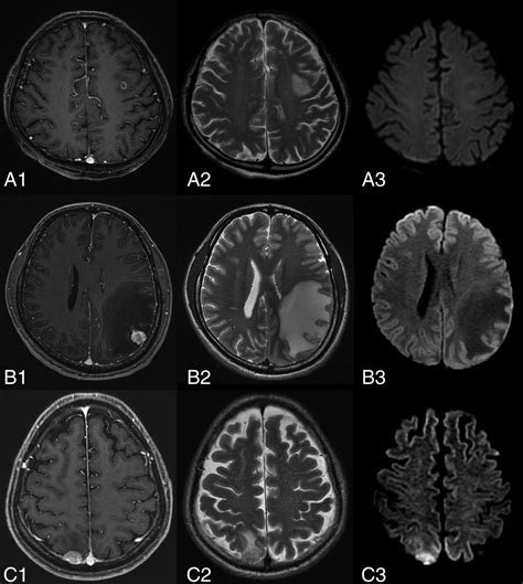 Diffusion Weighted Imaging Of Brain Metastasis From Lung Cancer