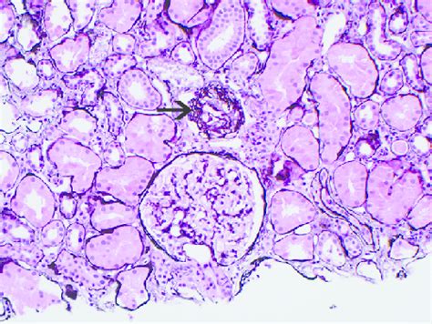 Renal Biopsy Specimen Shows A Normal Glomerulus And A Glomerulus With