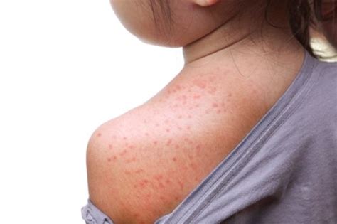 What Parents Need To Know During A Measles Outbreak Dr