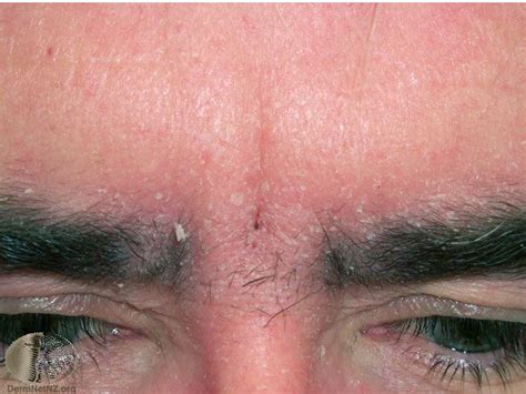 Seborrheic Dermatitis Pictures Scalp And Face Treatment Evidence