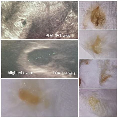 brownish discharge during pregnancy brown spotting at 4 weeks pregnant if brownish bleeding