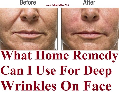 What Home Remedy Can I Use For Deep Wrinkles On Face Face Wrinkles