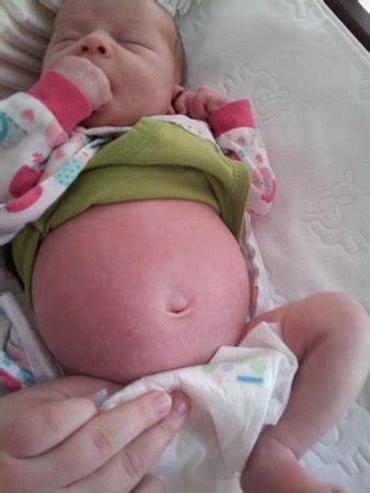 Bloated Belly Pic Babycenter