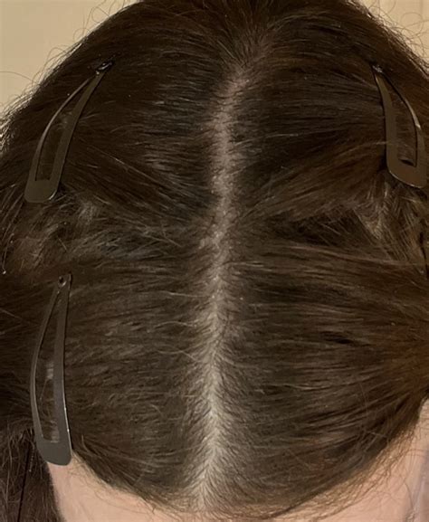 Why Am I Shedding — Donovan Hair Clinic