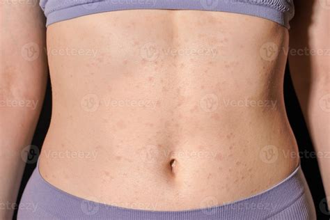 Red Allergic Rash On Stomach Skin Skin Allergy Atopic Dermatitis