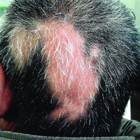 Case 3 A Round Well Defined Patch Of Hair Loss On The Scalp With A