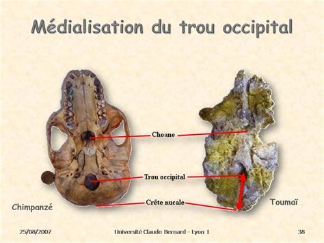 Medialisation Du Trou Occipital Medialisation Du Trou Occi Flickr