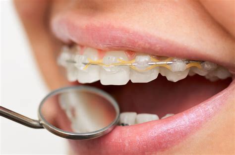 Caring For Your Braces Orthodontics In London