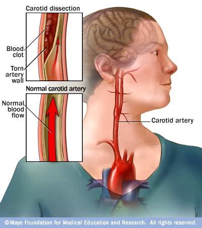 Megan S Ctmri Pathology Dissection Of Carotid Artery Vrogue Co
