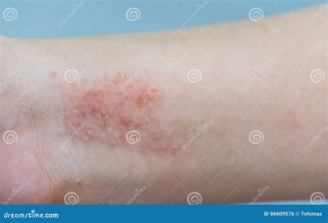 Atopic Dermatitis Symptom Skin Stock Photo Image Of Eczema Atopic