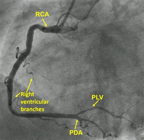 Coronary Circulation All About Cardiovascular System And Disorders