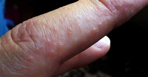 Eczema Eczema Blisters On Hands And Feet