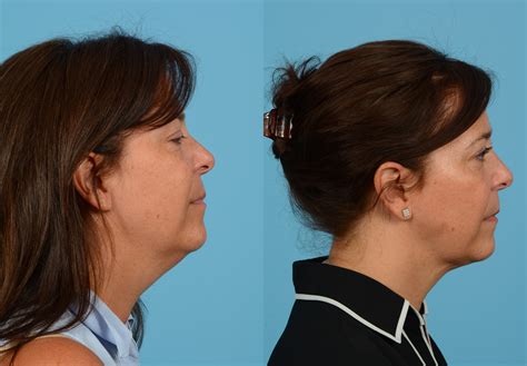 Submental Liposuction Before And After Patient 02 Dr Jeffrey Wise