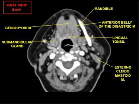 Figure 2 From Review Of Imaging Anatomy And Pathology Of The Floor Of