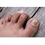 Fungal Toenail Infection  Causes & Treatment Qoctor Your Online Doctor