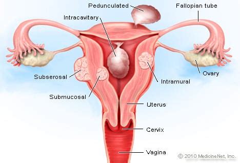 You can download free photos and use where you want. Uterine Fibroids Picture Image on RxList.com