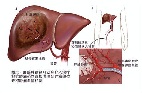 肝腫瘤介入治療之肝動脈栓塞化療術（tace） 每日頭條