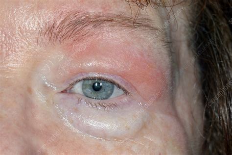 Swollen Eyelid Stock Image C Science Photo Library