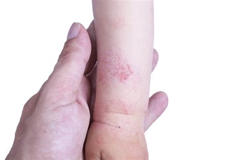 What Causes Itchy Skin In Children