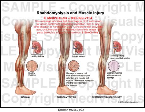 Medivisuals Rhabdomyolysis And Muscle Injury Medical Illustration
