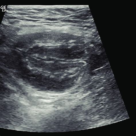 Normal Appearance Of The Umbilicus By Ultrasound Short Axis