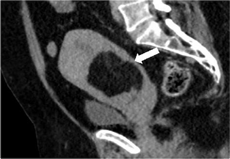 Sagittal Abdominopelvic Ct With Contrast Showing A Well Defined