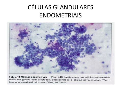 Componente Endocervical Zona De Transformação Presente é Grave