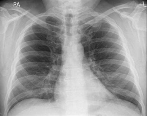 Chest Radiograph Demonstrates A Soft Tissue Mass In The Apex Of The