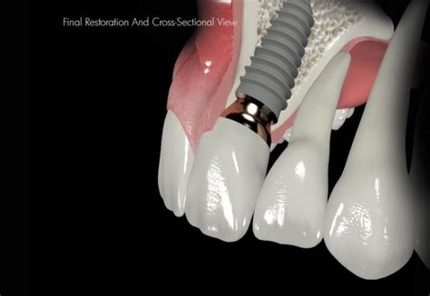 Single Anterior Implant 9 Woods Dental