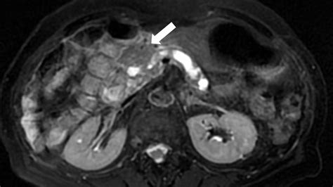Cureus Localized Pancreatitis In An Elderly Patient Without Suspected